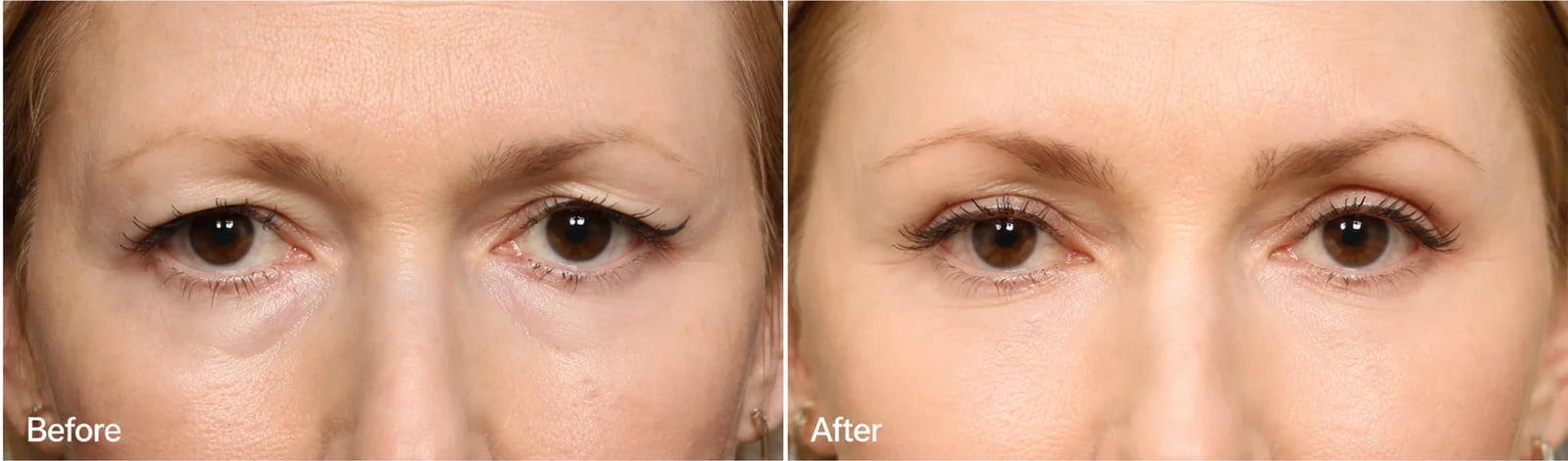 Brow lift before and after result by Dr. William Harris, Beverly Hills