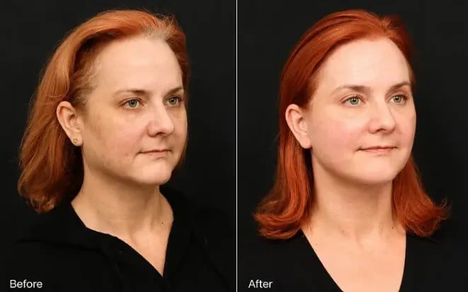 Before and after a deep plane facelift, three-quarter view