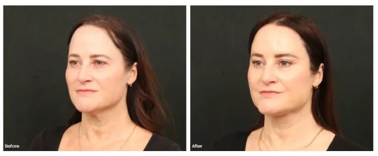 Before and after photos of a woman's lower face and neck, three-quarter view