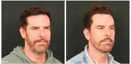 Before and after facelift photos of a man with a beard, three-quarter view