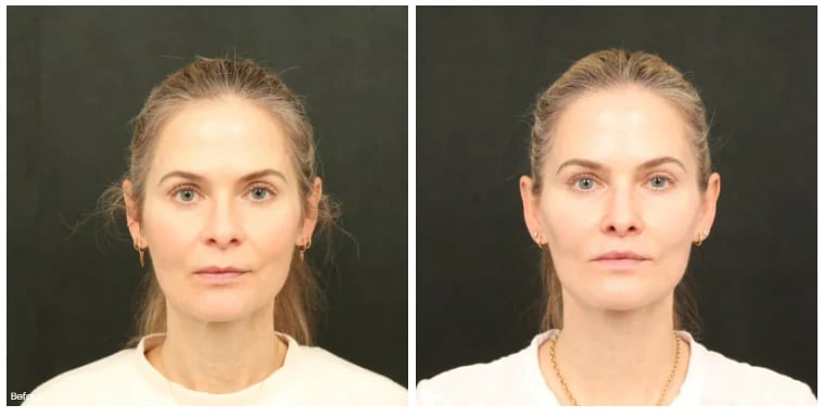 Before and after facelift, front view, showing a smoother jawline and neck