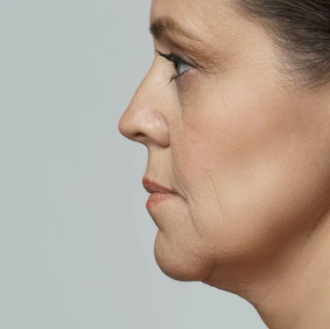 Profile view showing jawline and neck definition after facelift