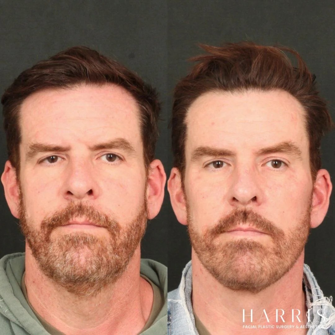 Beverly Hills deep plane facelift before and after result by Dr. William Harris