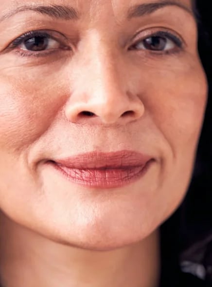 Smooth, refined skin texture — the even tone fractional laser resurfacing improves
