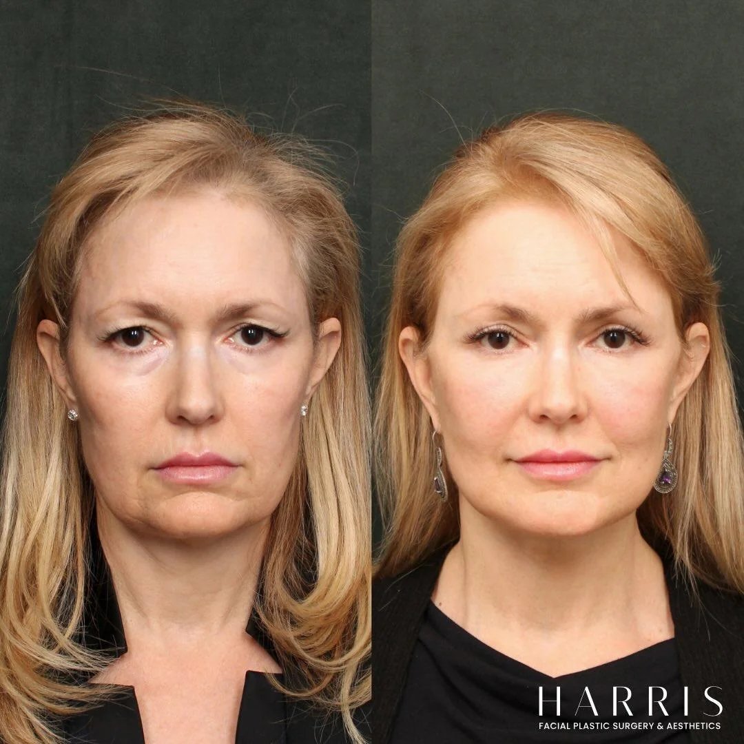 Beverly Hills deep plane facelift patient