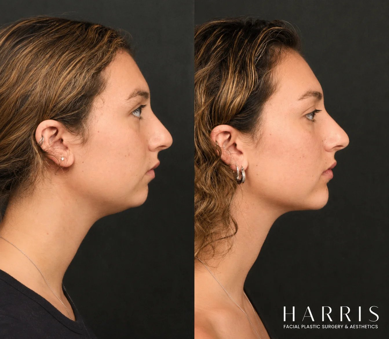 Beverly Hills chin implant patient