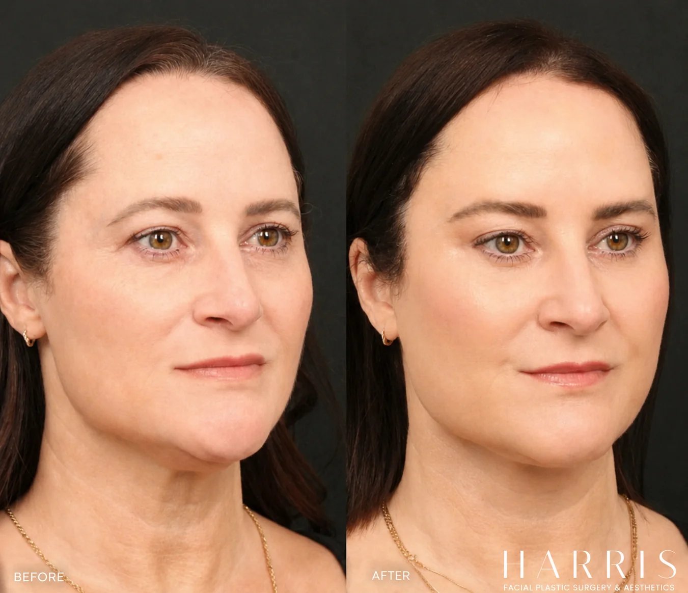 Beverly Hills brow lift patient