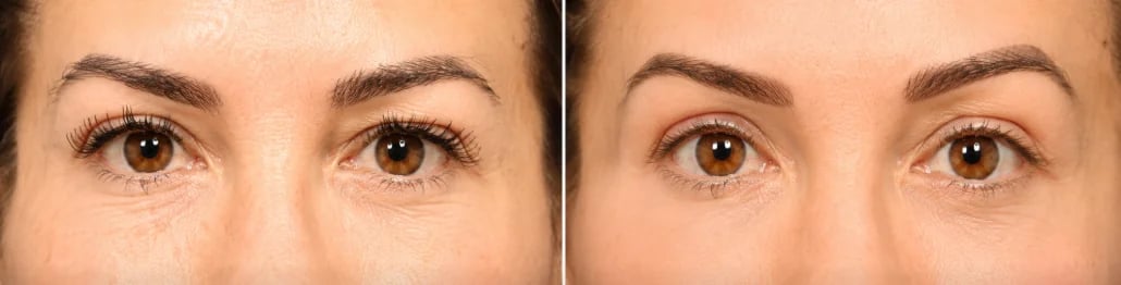 Beverly Hills brow lift before and after result