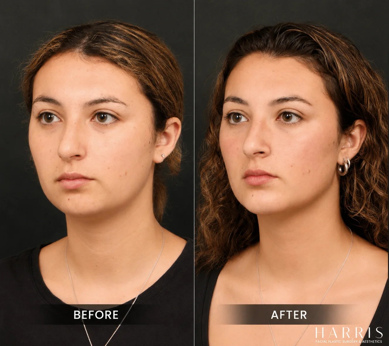 Beverly Hills chin implant patient