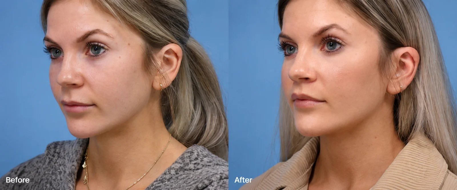 Beverly Hills lip lift before and after result