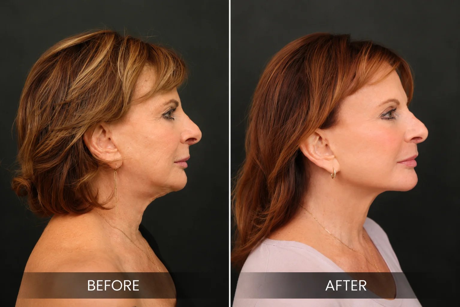 Beverly Hills facial plastic surgery before and after result
