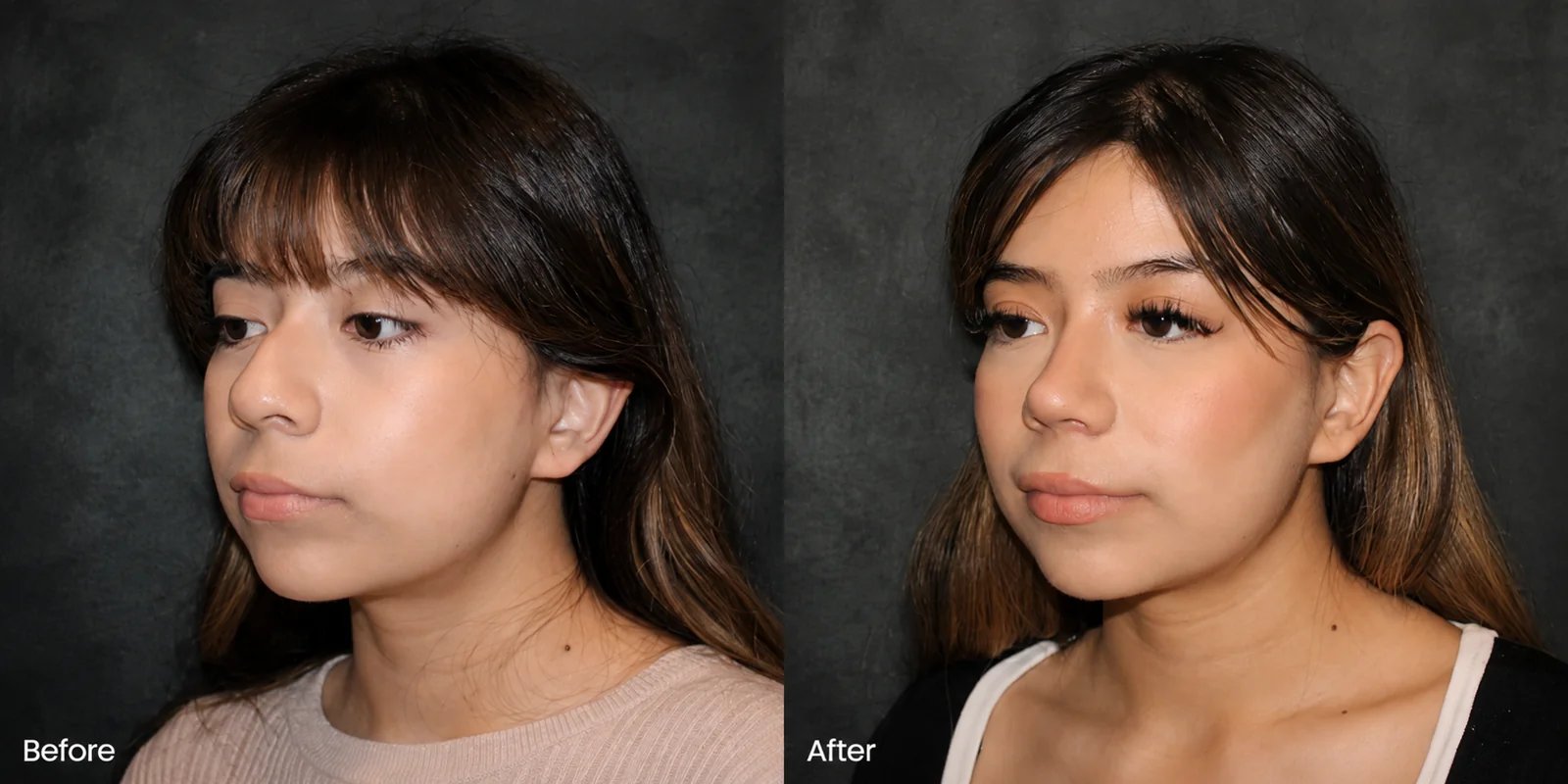 Beverly Hills facelift before and after result