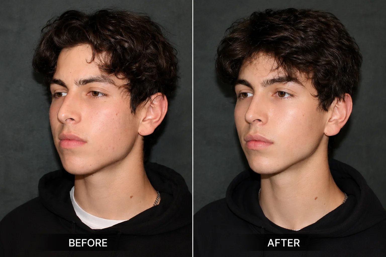 Beverly Hills rhinoplasty before and after result