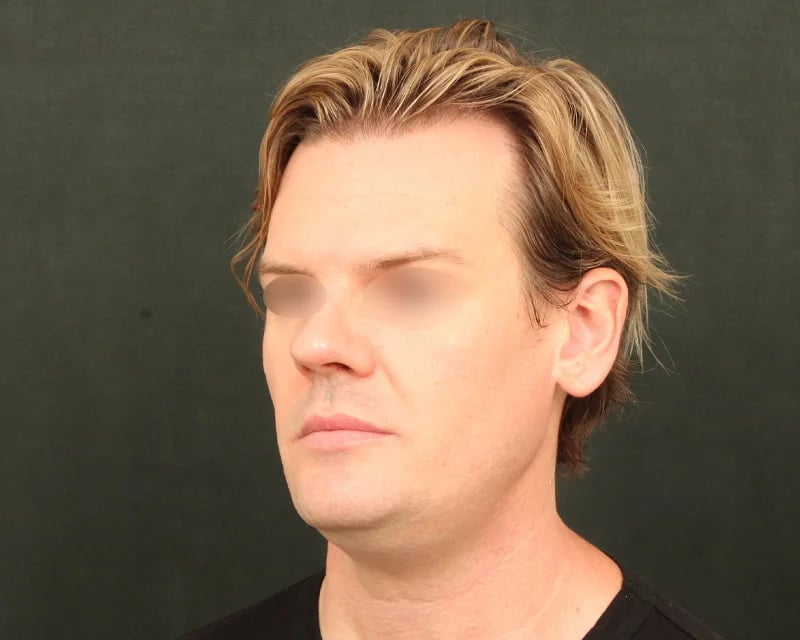 Holiday Neck Lift real patient before and after photos