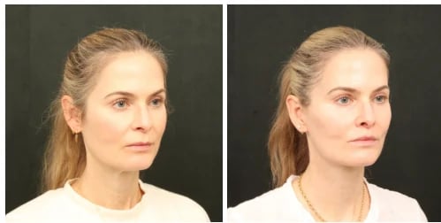 Before and after facelift photos of a woman, three-quarter view, matched lighting and pose