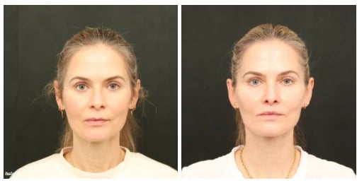 Before and after facelift photos of a woman, front view, matched lighting and pose