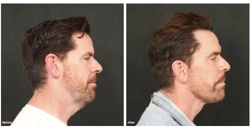 Before and after facelift photos of a man, side profile showing the jawline and neck