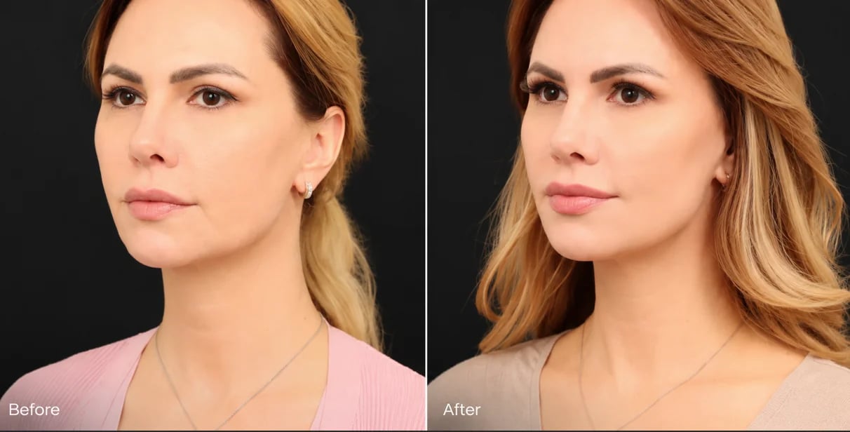 Lip lift before and after by Dr. William Harris, Beverly Hills