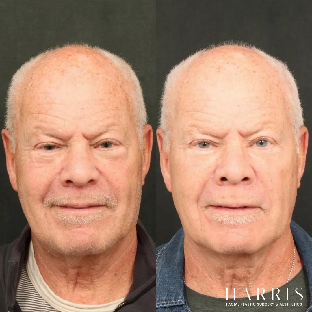 Beverly Hills lower blepharoplasty patient before and after photo