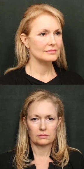 Front and three-quarter views of a facelift patient showing the jawline and lower face