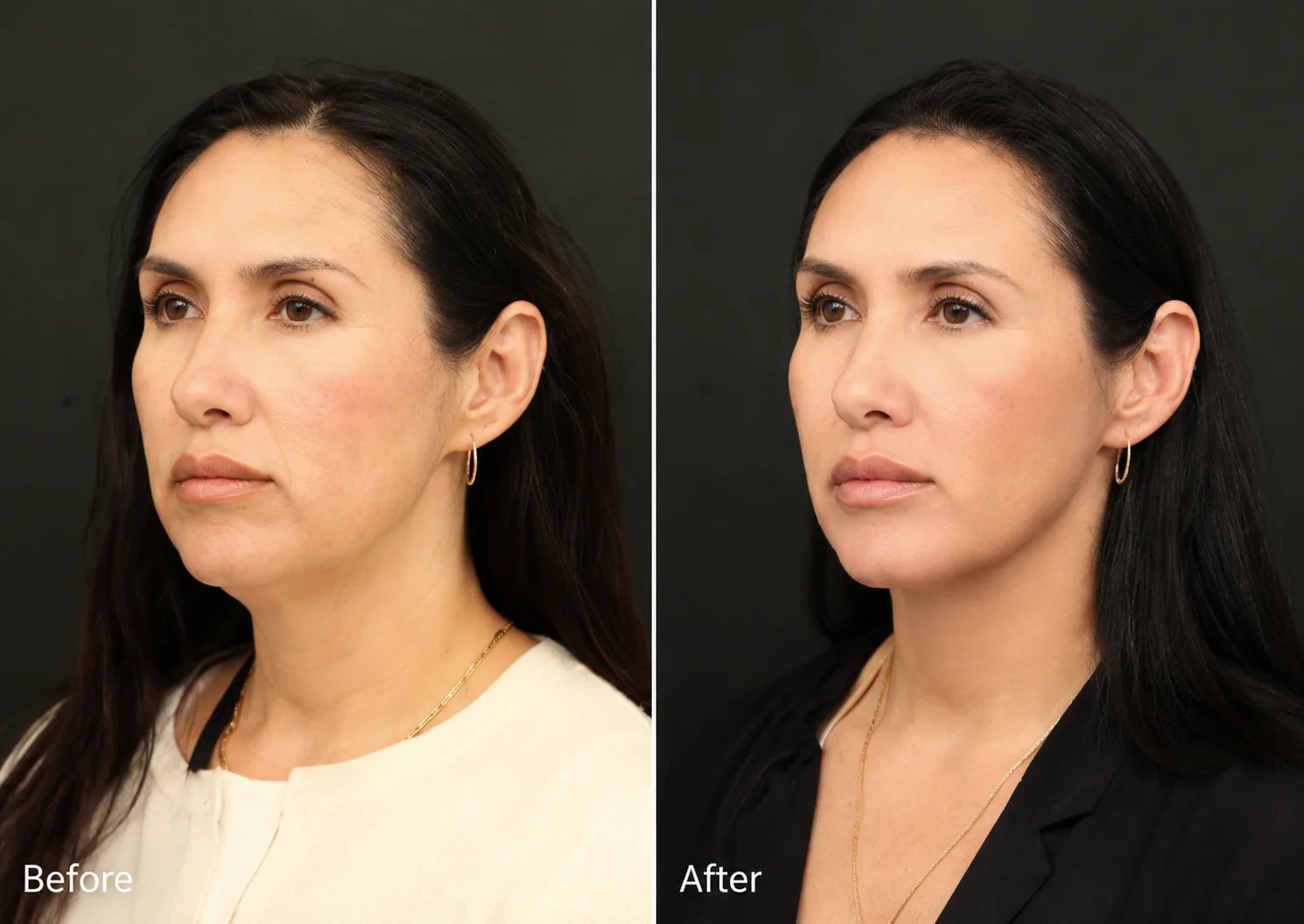 Beverly Hills neck lift patient before and after result