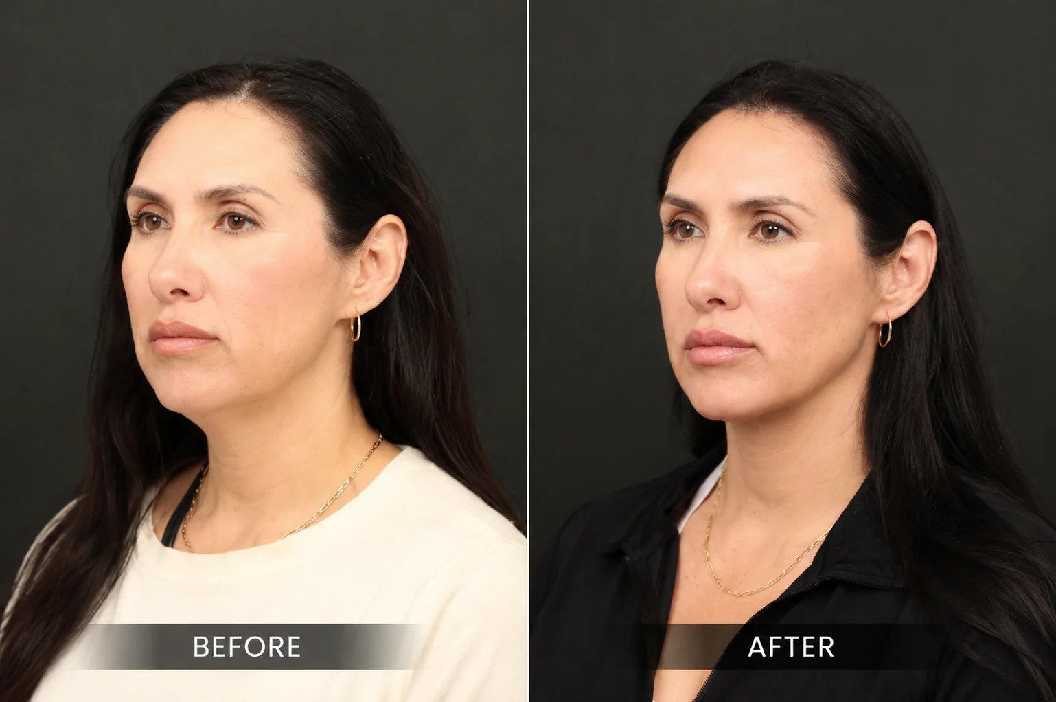 Neck lift before and after, performed by Dr. William Harris, Beverly Hills