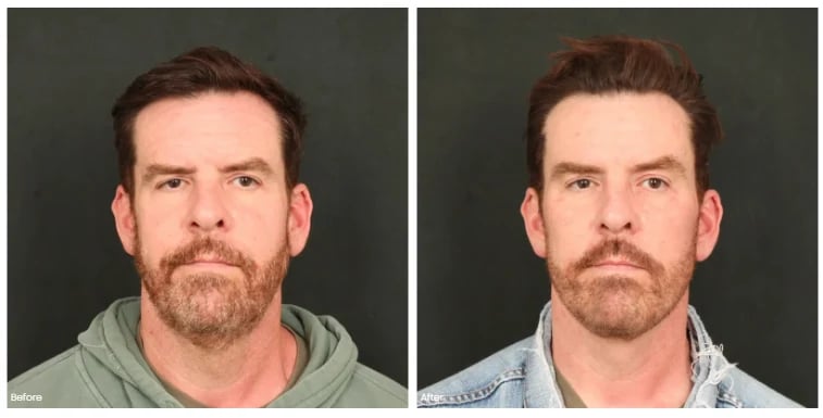 Before and after facial plastic surgery on a male patient, front view