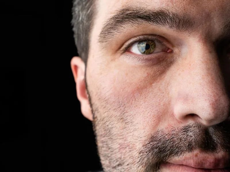 Upper Blepharoplasty
