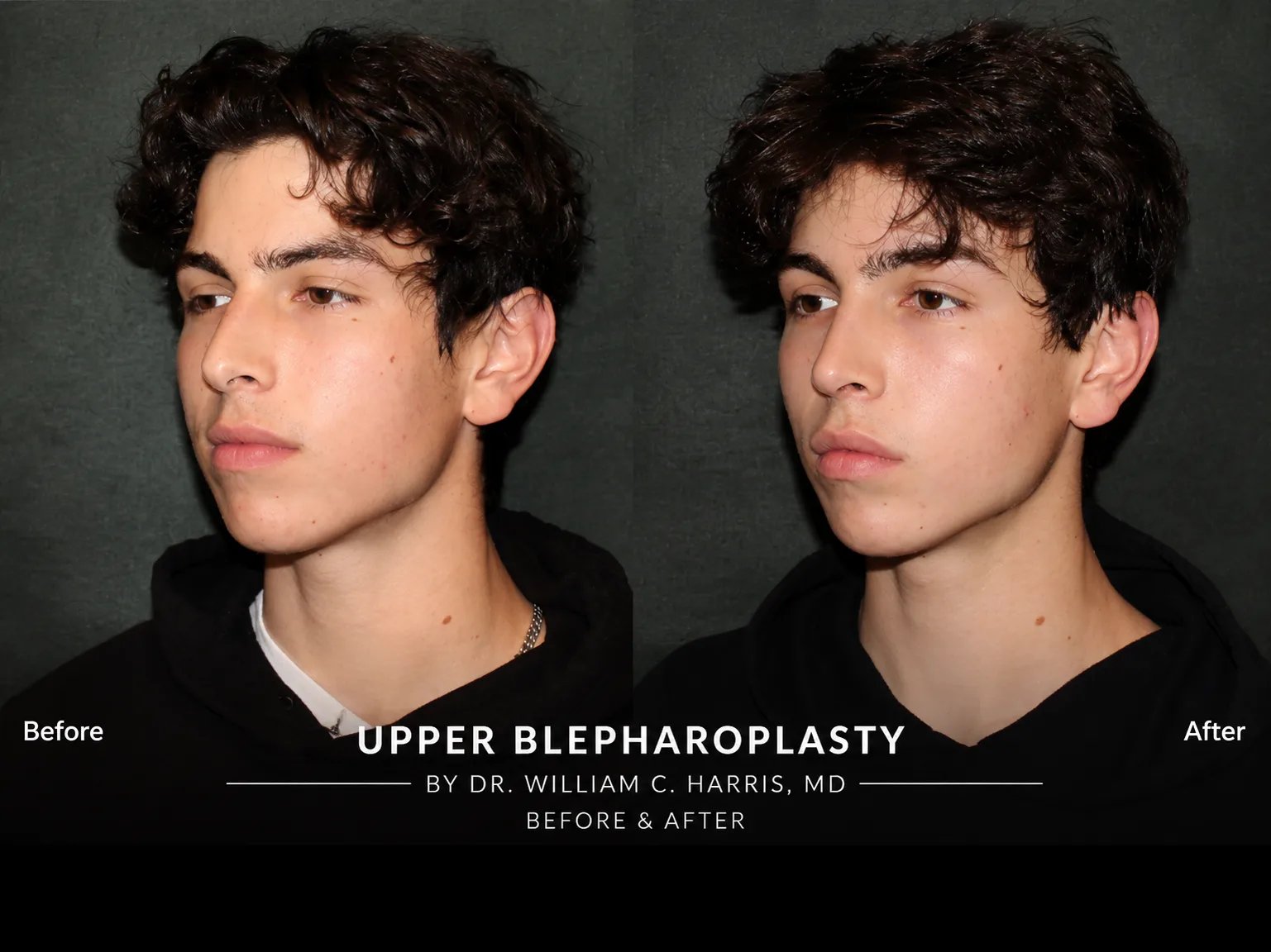 Beverly Hills upper blepharoplasty patient before and after photo