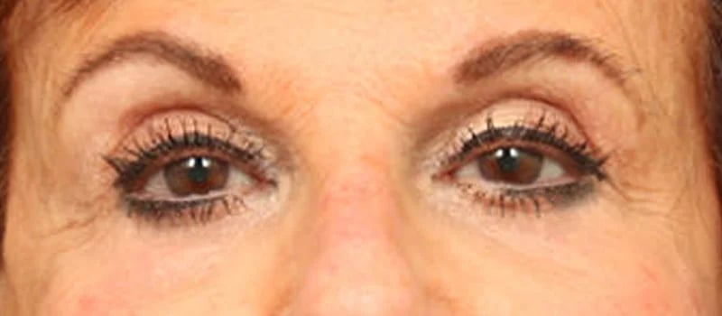 Brow / Temple Lift Before & After Image