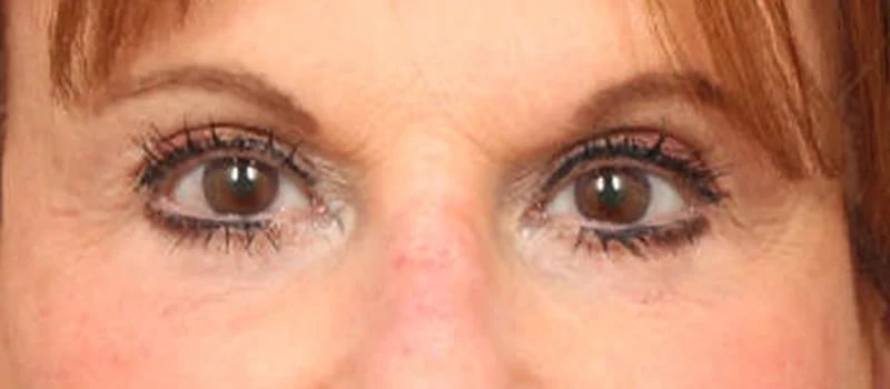 Brow / Temple Lift Before & After Image