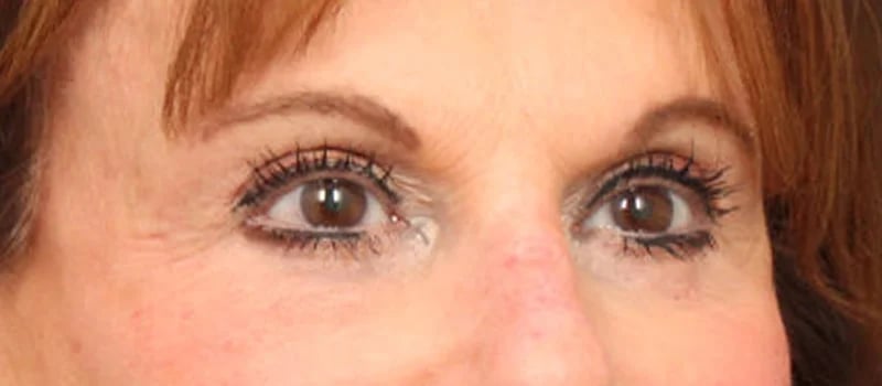 Brow / Temple Lift Before & After Image