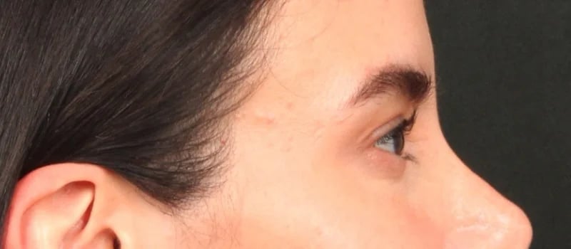Brow / Temple Lift Before & After Image