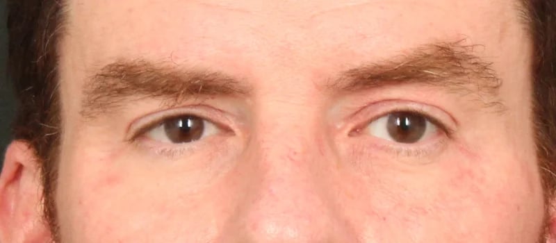 Brow / Temple Lift Before & After Image