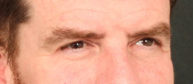 Brow / Temple Lift Before & After Image