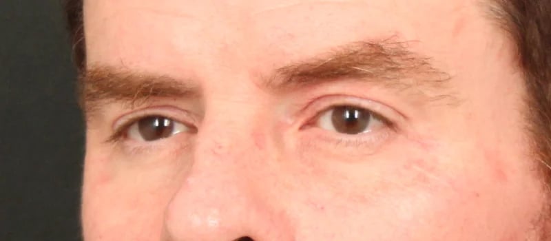 Brow / Temple Lift Before & After Image