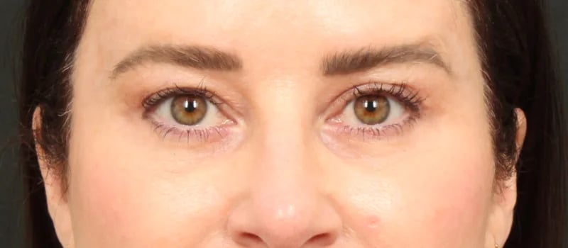 Brow / Temple Lift Before & After Image