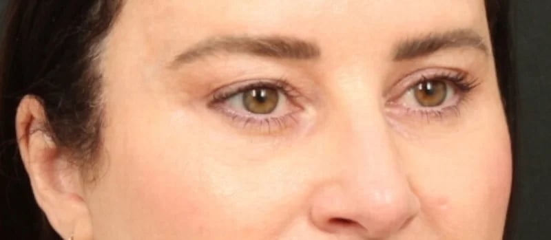 Brow / Temple Lift Before & After Image