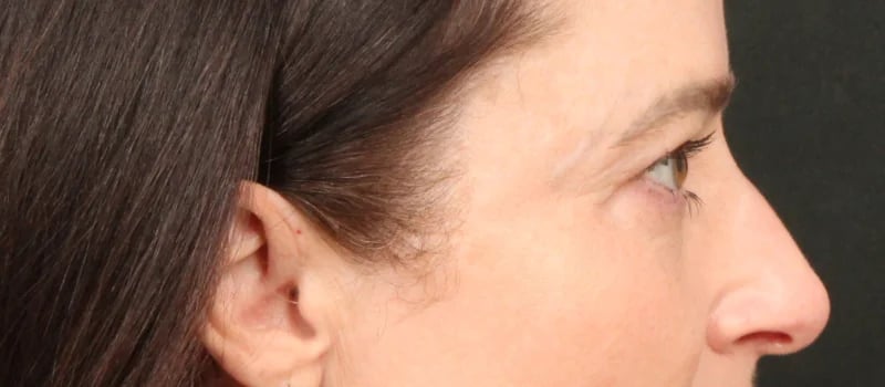 Brow / Temple Lift Before & After Image