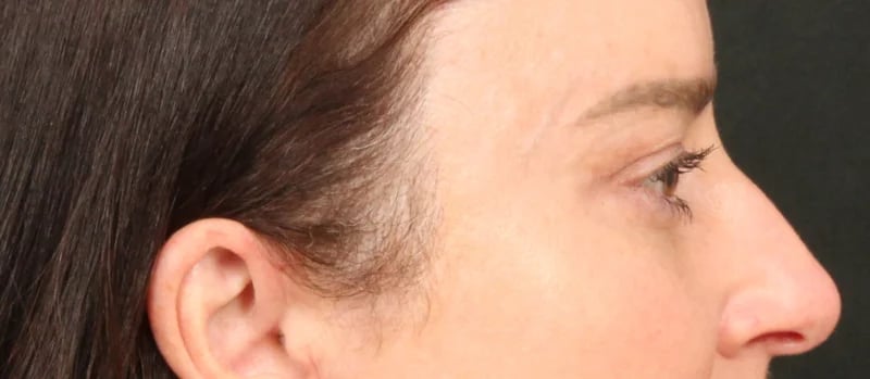 Brow / Temple Lift Before & After Image