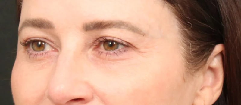 Brow / Temple Lift Before & After Image