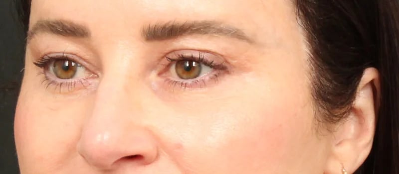 Brow / Temple Lift Before & After Image