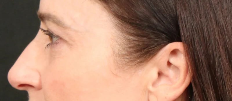 Brow / Temple Lift Before & After Image