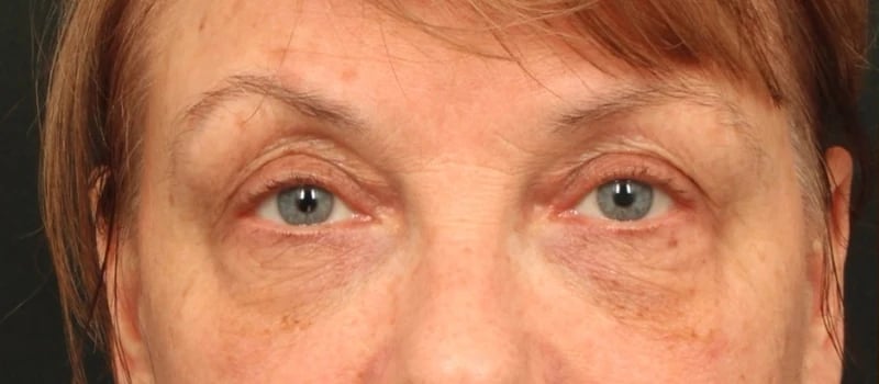 Brow / Temple Lift Before & After Image