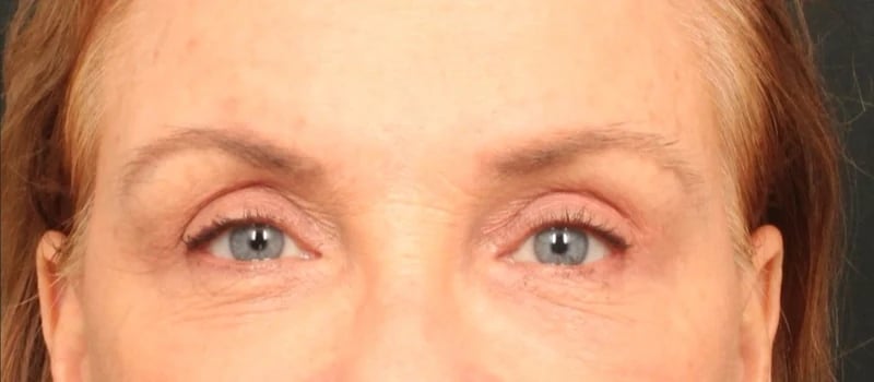 Brow / Temple Lift Before & After Image