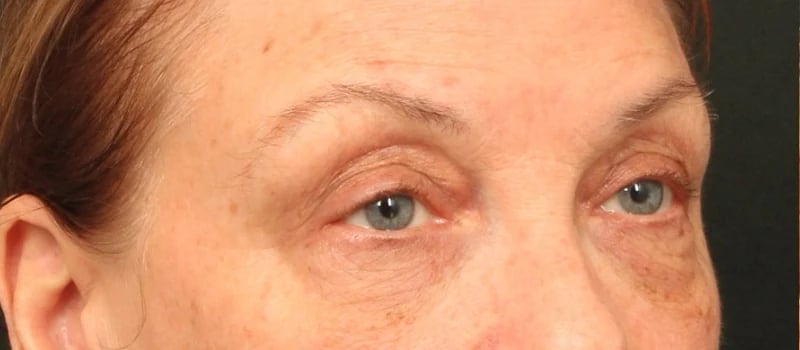 Brow / Temple Lift Before & After Image