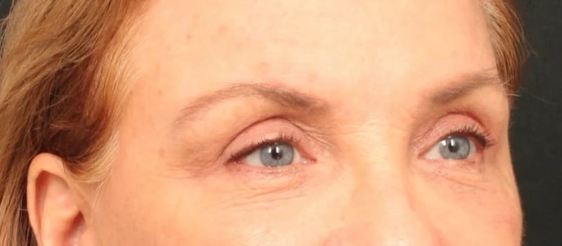 Brow / Temple Lift Before & After Image