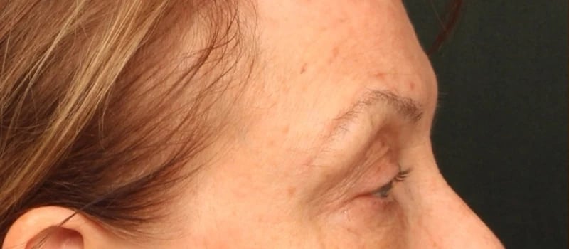 Brow / Temple Lift Before & After Image