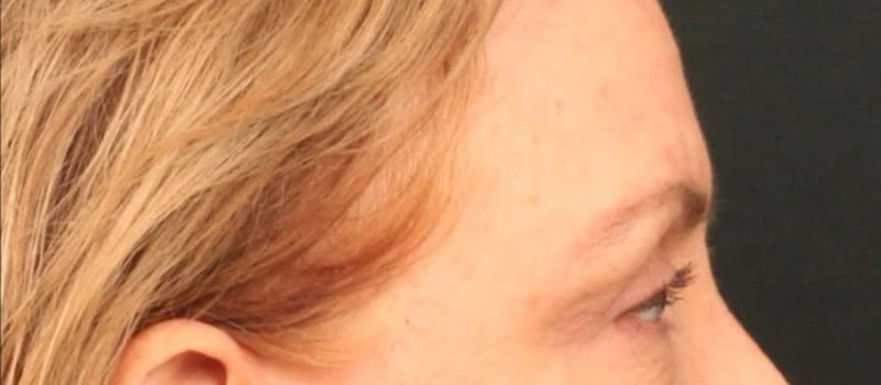 Brow / Temple Lift Before & After Image