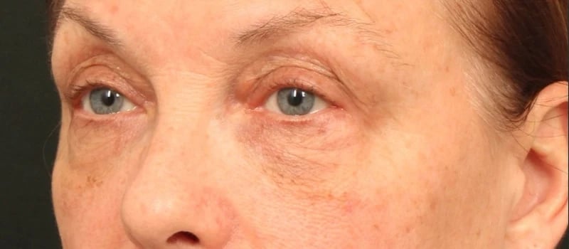 Brow / Temple Lift Before & After Image